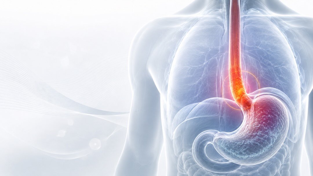 Esôfago de Barrett: cirurgia cura, reduz risco ou apenas controla o refluxo?