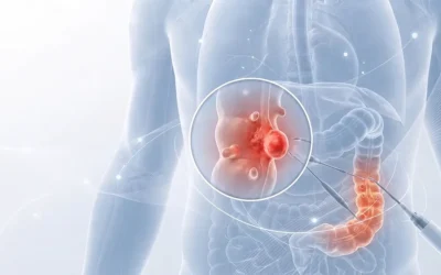 Diverticulite: tratamento e quando operar