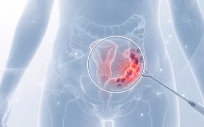 Endometriose intestinal: sintomas e diagnóstico