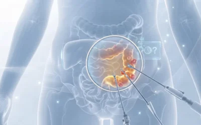 Diverticulite recorrente: operar ou esperar?