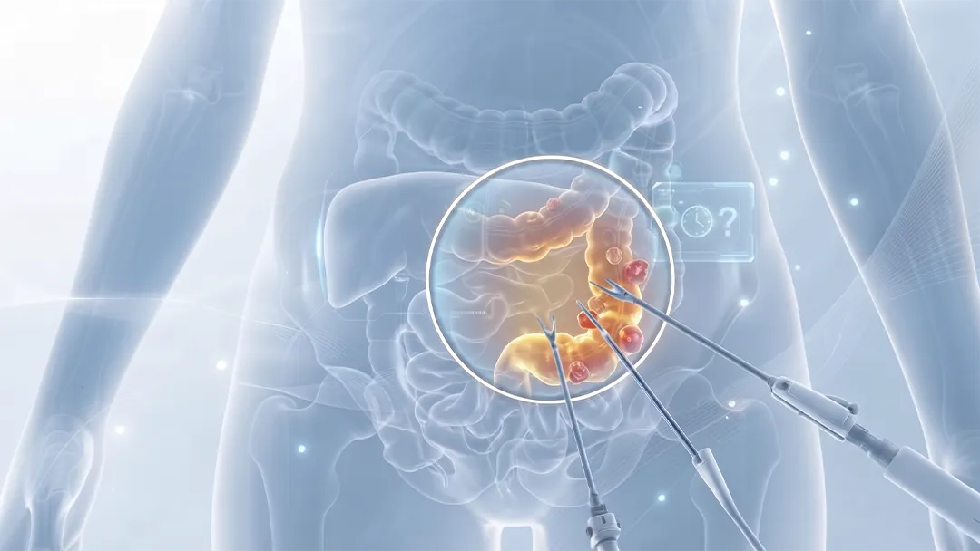 Diverticulite recorrente: operar ou esperar?